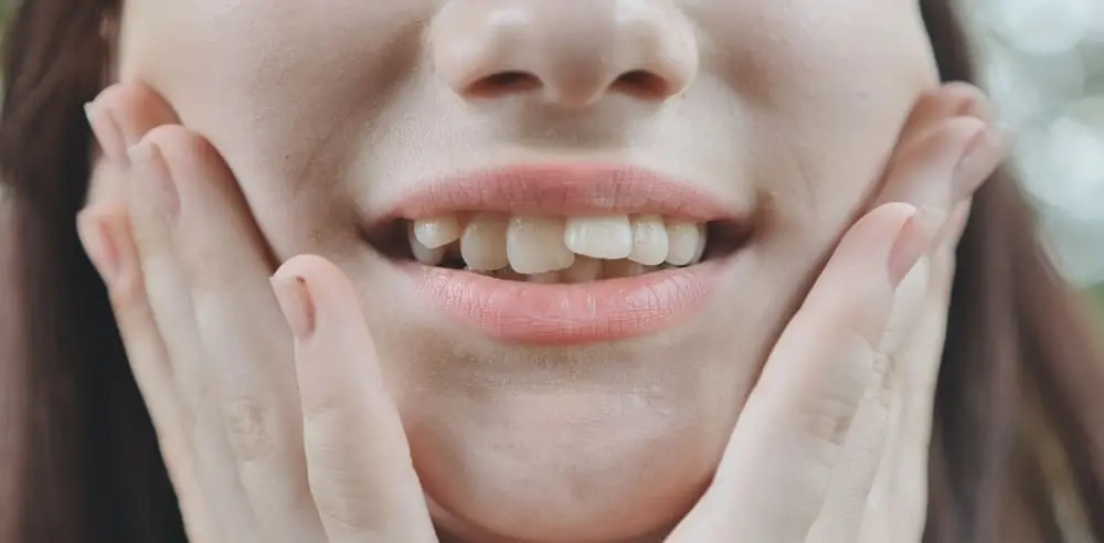 apinamiento-dental-leve